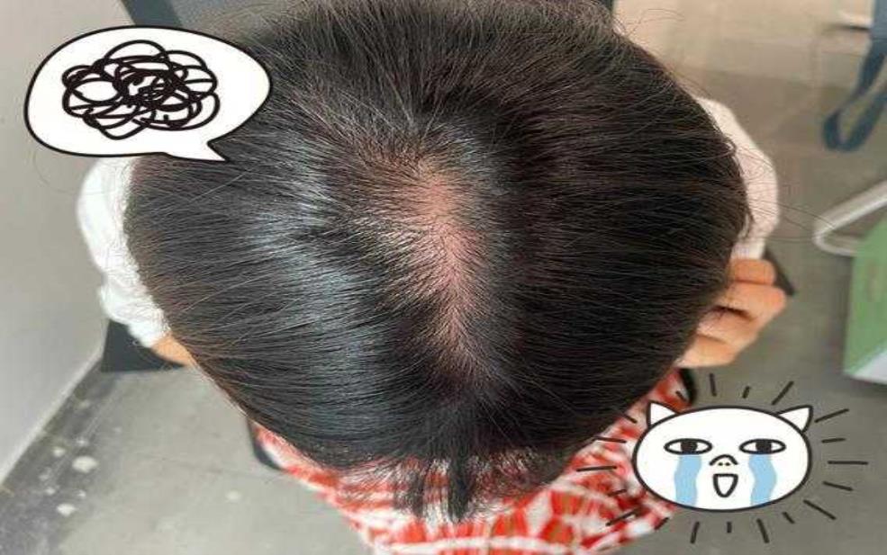天气冷头顶受凉:会影响健康吗?